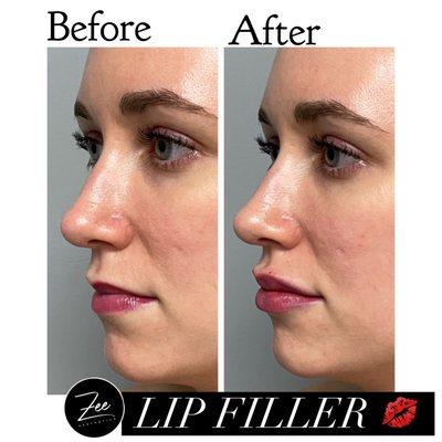 Lips Before/After