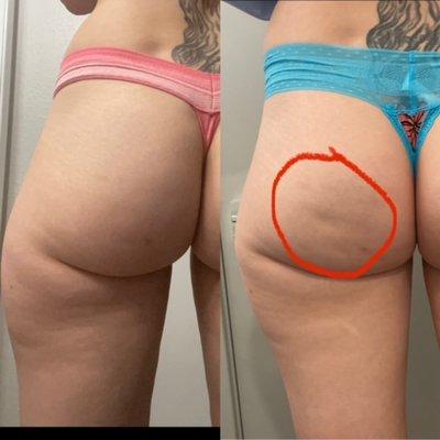 Cellulite reducer, skin tightening