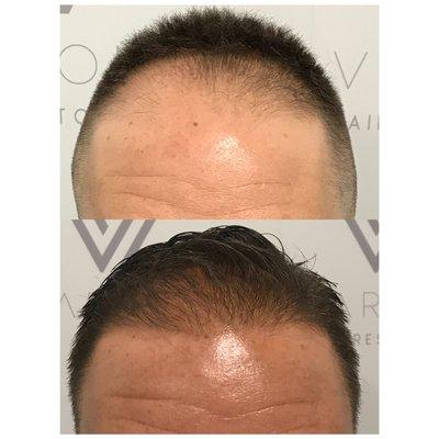 6 month update after 2292 manual FUE grafts placed extracted and placed by me. Caliber of the hairs will thicken over the next six months.