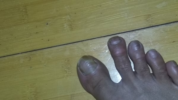 Toe nail fungus from them not cleaning tools dirty towels and old polish