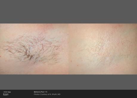 Laser Hair Removal