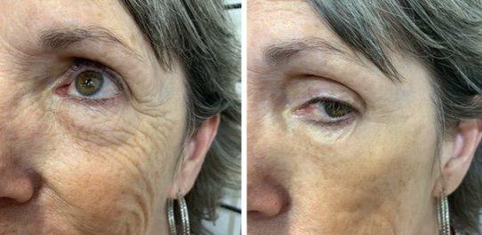 Before and after our anti-aging treatments