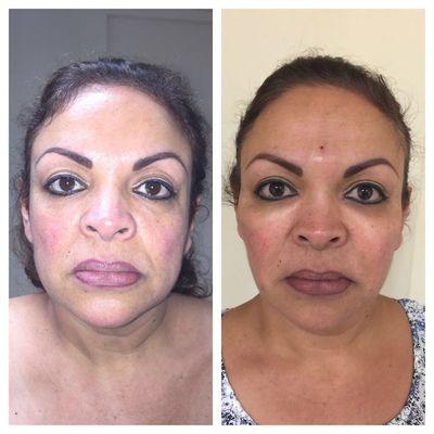 After photo on right taken 15 minutes after ALMI procedure!