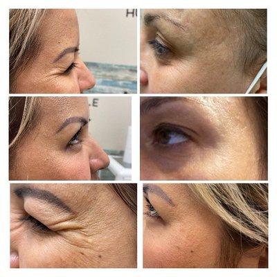 Before & After Treatment wth Botox/Xeomin to the Crows Feet