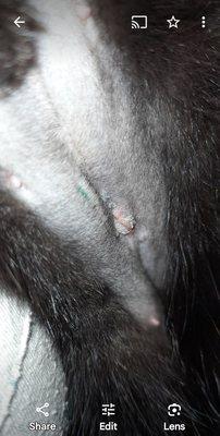 This is Angel. The incision has a few layers of dissolvable stitches on the inside and glue on the outside.