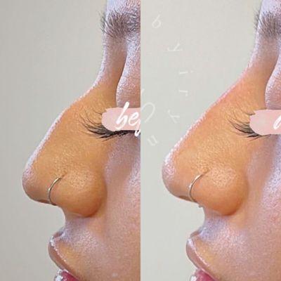 Non-surgical Rhinoplasty
 @rejuvenationbyirina