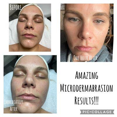 Microdermabrasion Facial