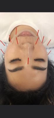 Japanese facial rejuvenation treatment