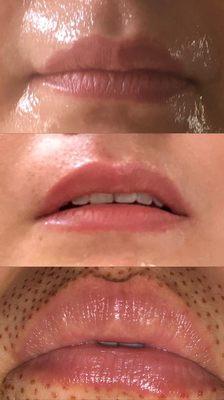 Lip lift with fibroblast