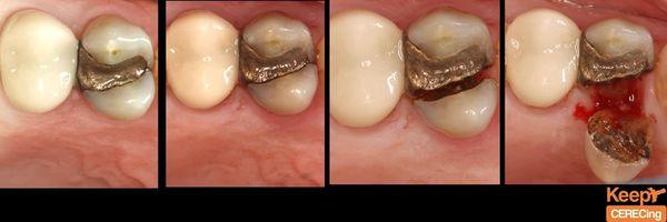 How a small fracture leads to broken tooth