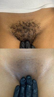 Brazilian Wax