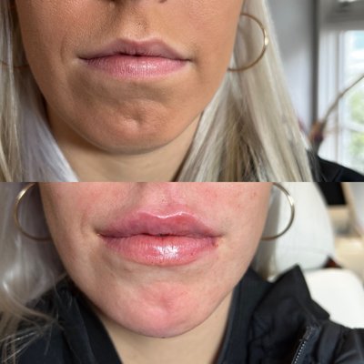 Lip & chin filler for facial balancing