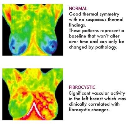 Examples of a Normal breast thermogram versus a Fibrocystic thermogram