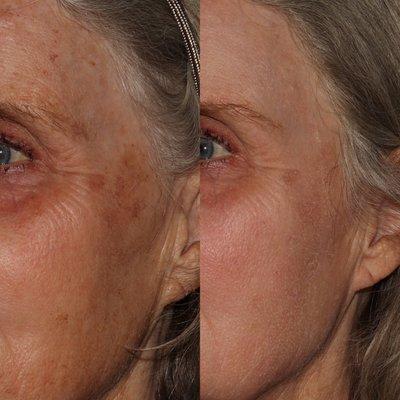 Cosmelan MD helps reduces stubborn pigmentation and melasma