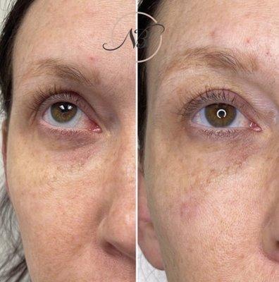 1 syringe of Voluma to the undereyes for a more soft and refreshed look