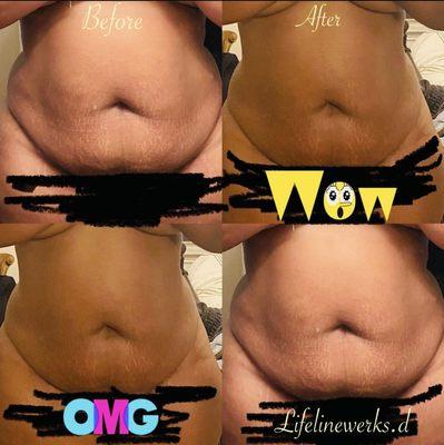 Service performed: Laser lipo, Cavitation, Skin Tightening, and Vacuum Therapy for 30 days.