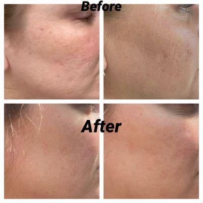 First photo is before, after is after 2 microneedling treatments.