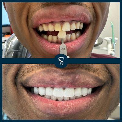 Cosmetic Dentistry and Porcelain Veneer Before and After