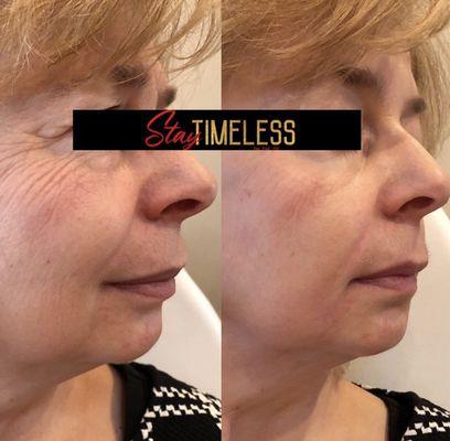 Dermal filler and Botox treatment