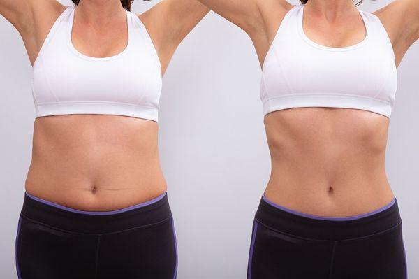 Ultrasonic Cavitation is a safe ans less invasive alternative to liposuction.