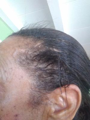 Hair breakage/damage