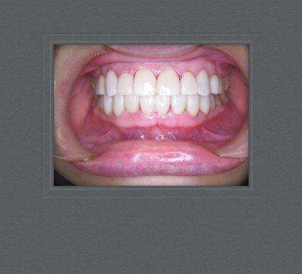 Veneers