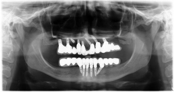 Here is an X-Ray of the malpractice done at American Dental.  Horizontal implants, one (in the left top front) goes thru sinus into nose!!