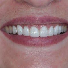 Veneers