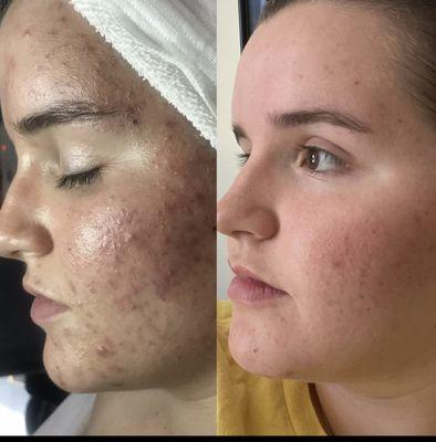 Acne Bootcamp Before and After