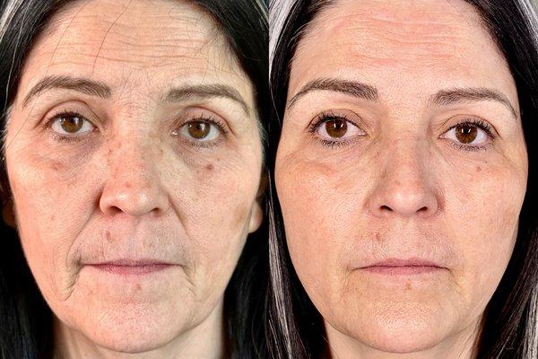 Amazing Fibroblast Transformation! Results shown are 12 weeks post 1 Full Face Fibroblast treatment.