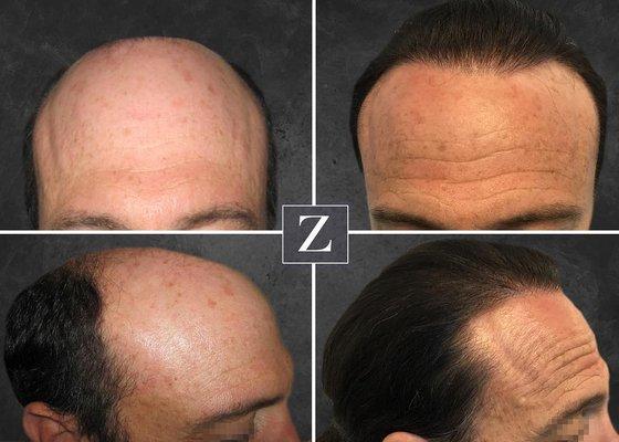 Male Hair Rejuvenation - FUE FUT