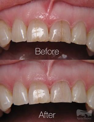 This patient had a stained enamel crack on one of her front teeth, so we cleaned out the crack and fixed the chipped edge as well.