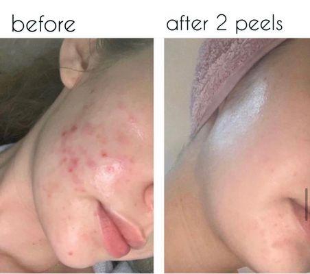 Before & After Chemcial Peels