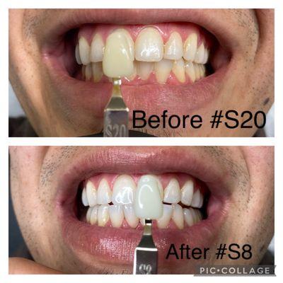 Premium teeth whitening 1 hr session