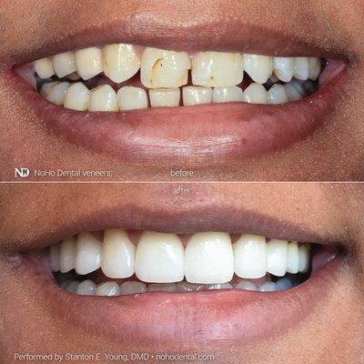 Dental veneers by Dr. Young on upper incisors and canines brighten this patient's smile while being in a natural harmony with their face.