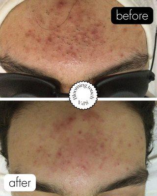 acne treatment, black heads extractions