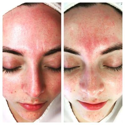 First time micro-current treatment. Redness and glabella wrinkles are reduced. Face muscle reprogramming works!!