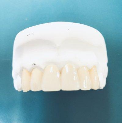 Real looking zirconia crown. We can match the any color shade with rest of your teeth.