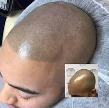 SMP Scalp Micropigmentation