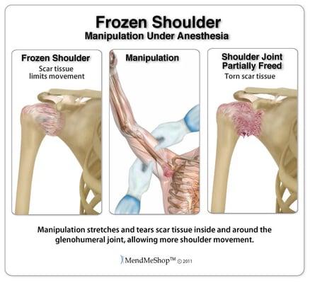 Frozen Shoulder can be treated and fixed with specific soft tissue work here at Pro Massage.