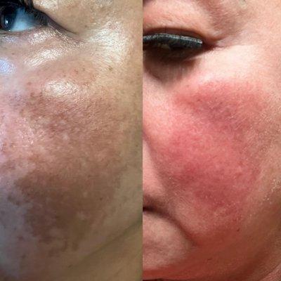 Melasma Progress