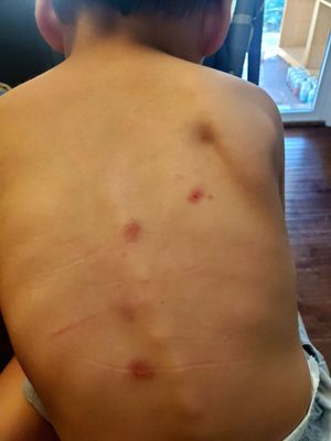 The concerning bruises on my son's back that none of the preschool caretakers were able to explain