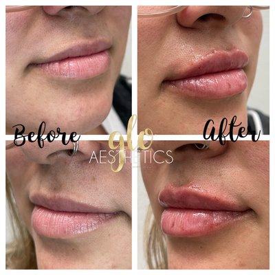 Juicy lips filler