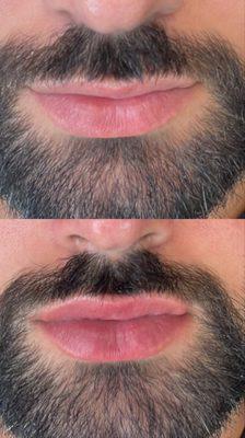 Only after 1 session of Lip Microneedling!! This is a great natural way to plump and hydrate your lips!