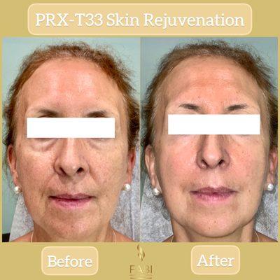 Full Face Skin Rejuvenation