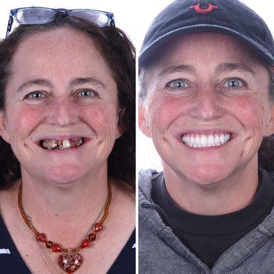 Final result of full mouth dental implants!