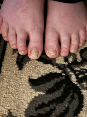 You can see how short my toenails are and how curved the 2 big toes are, especially the left one (your right).