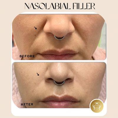 Nasolabial filler