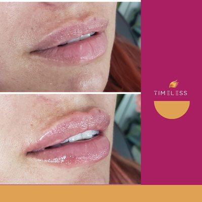 Natural lip filler with Versa/Revanesse Lips