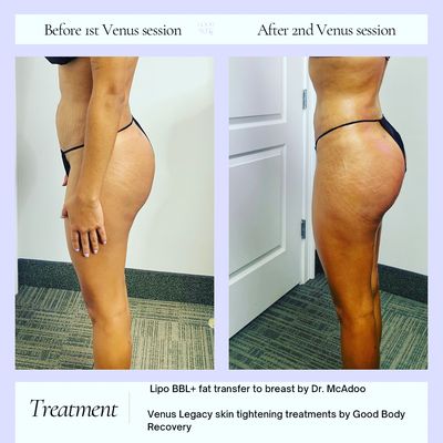 Venus Legacy Skin Tightening